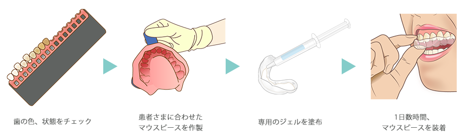 ホームホワイトニングの流れ