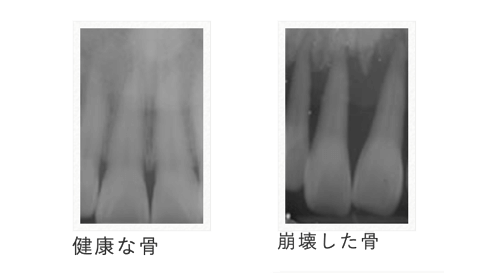 歯周炎