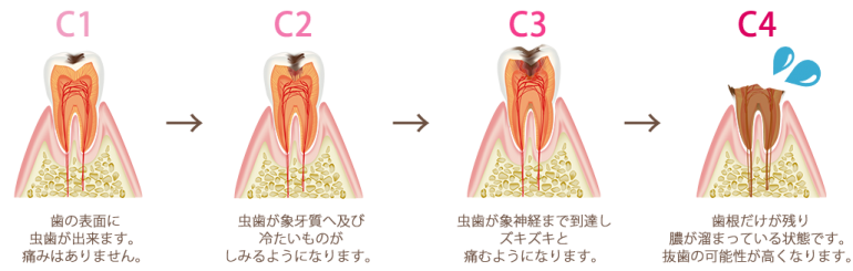 むし歯の進行