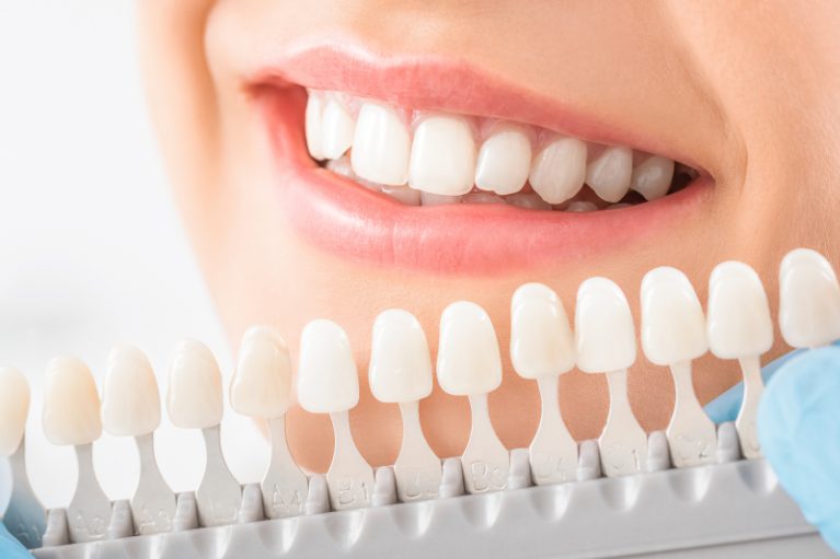 ボーテ式ホワイトニング