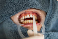 ホワイトニング剤塗布