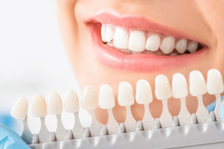 【新導入】ボーテ式ホワイトニングを開始しました