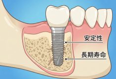 インプラント:10年後も後悔しない選択