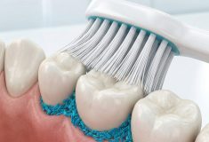 セルフケアの限界：磨いているのに虫歯になる理由